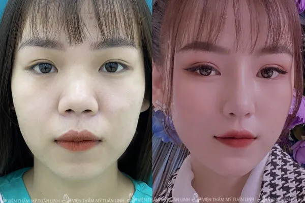 Bấm Mí Mắt
