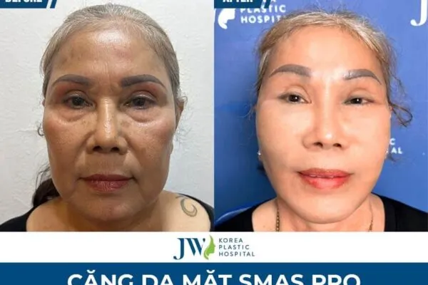 Căng Da Mặt Smas