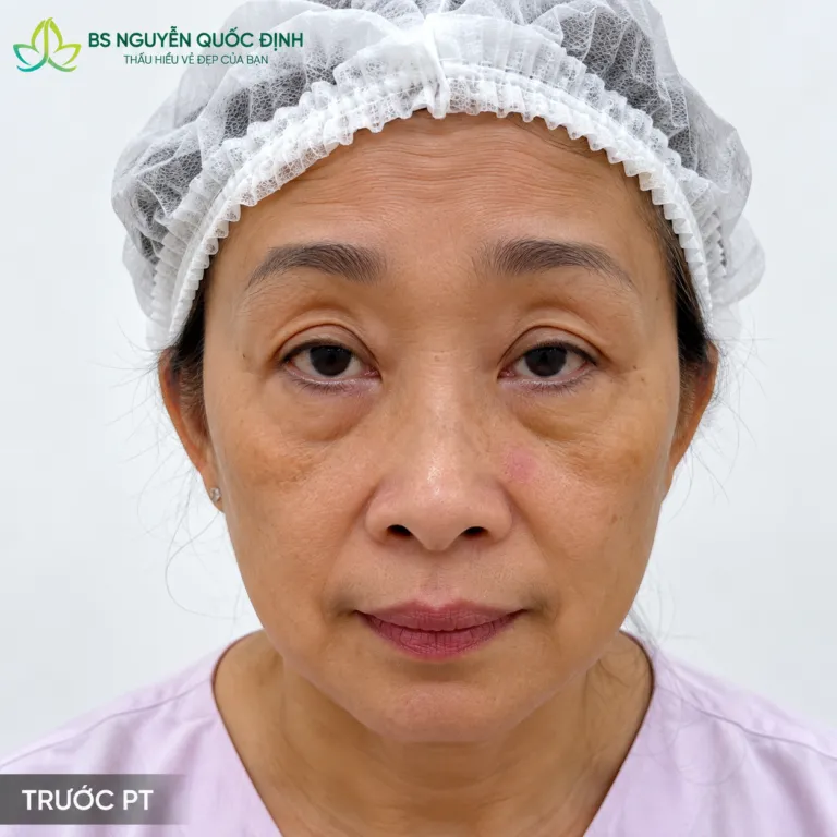 Căng da mặt nội soi & Cấy mỡ Bio-Fat trước