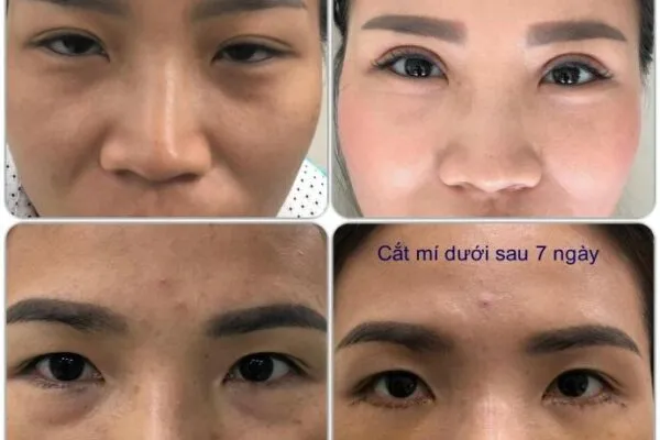 Cắt Mí Mắt