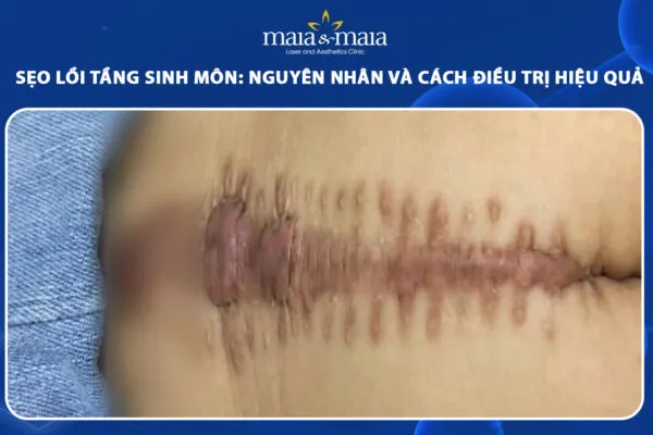 Chỉnh Sẹo Xấu Tầng Sinh Môn