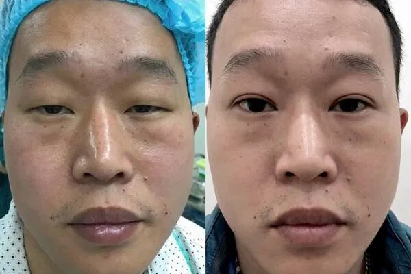Chỉnh Sụp Mí Bẩm Sinh
