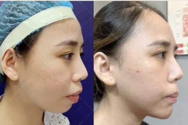 Độn Cằm (Korea Implant)
