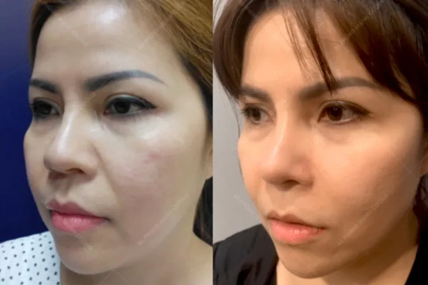 Độn Rãnh Mũi Má