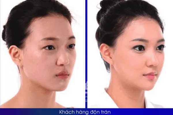 Độn Trán