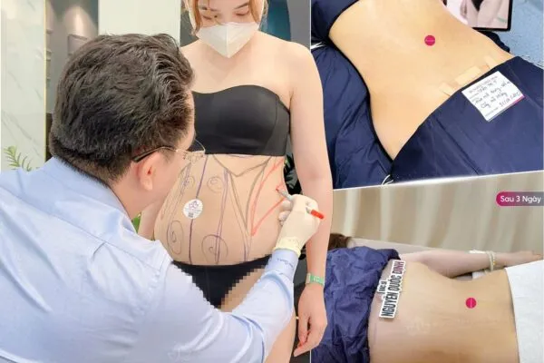 Liposuction