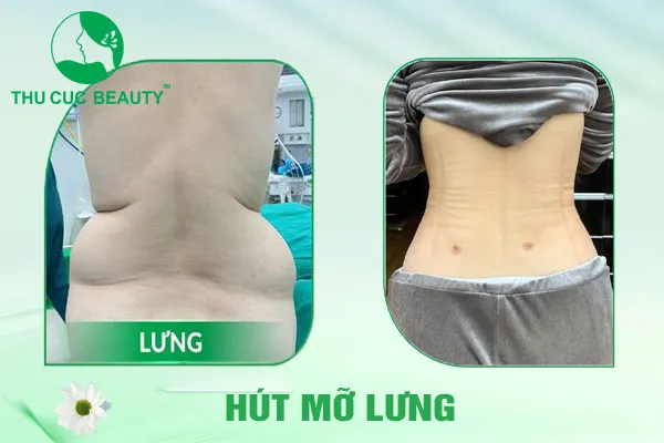 Hút Mỡ Lưng