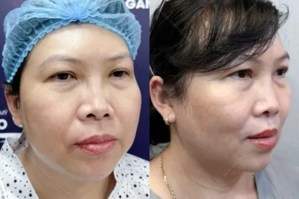 Hút Mỡ Má