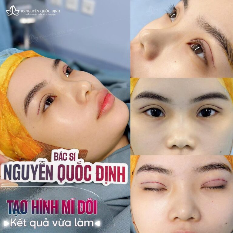 Cắt mí Plasma & Lấy mỡ thừa bọng mắt trước