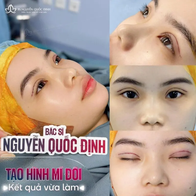 Cắt mí Plasma & Lấy mỡ thừa bọng mắt trước