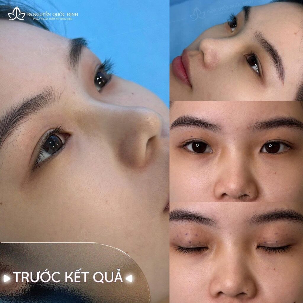 Xử lý mũi viêm sau nhiều lần phẫu thuật