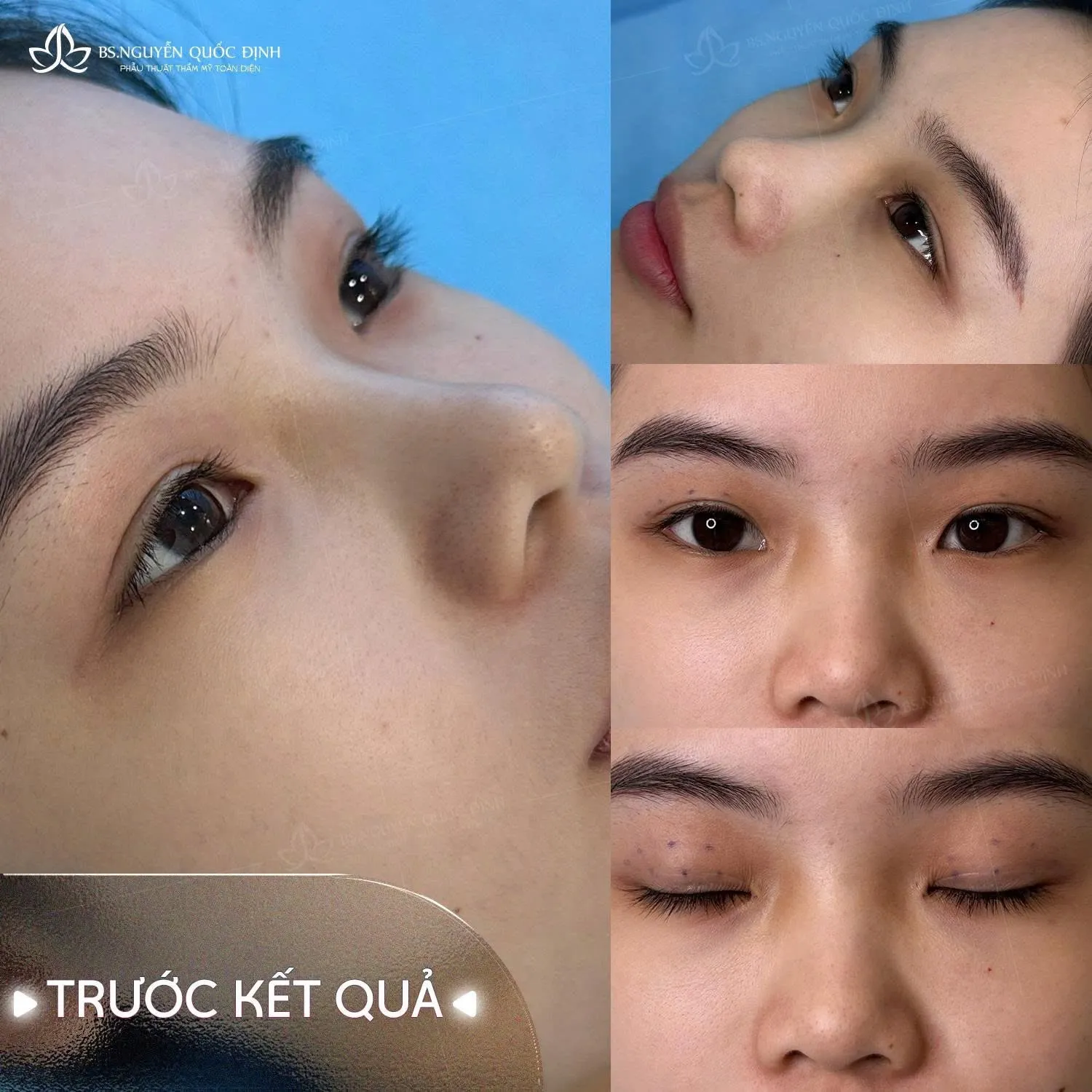 Chị Hoàng Oanh (29t, Cần Thơ) – Kích mí đôi