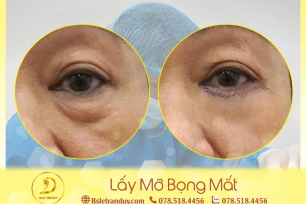 Lấy Mỡ Mí Mắt