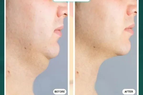Lấy Mỡ Nọng Cằm