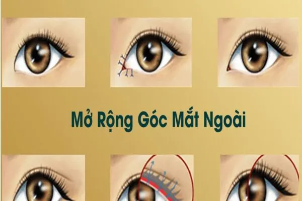 Mở Rộng Góc Mắt Ngoài Và Trong