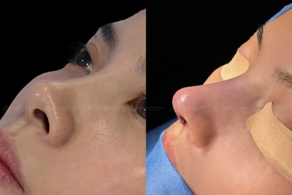 Rhinoplasty