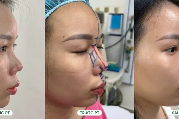 Nâng Mũi Sụn Sườn