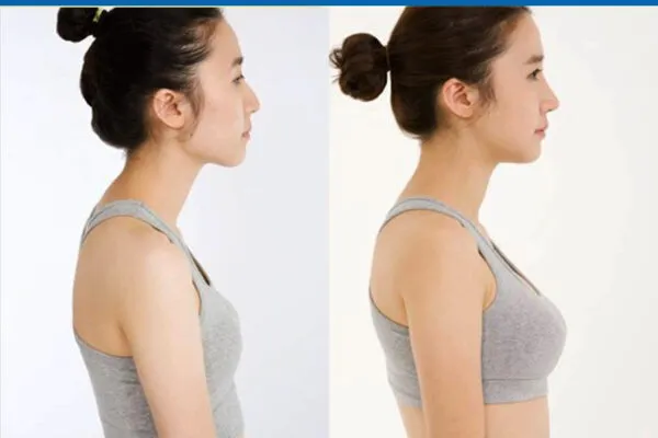 Nâng Ngực Bằng Mỡ Tự Thân