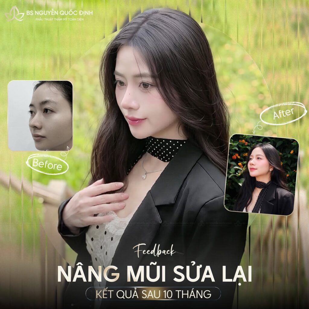 SỬA MŨI LẦN THỨ 3 BẰNG SỤN SƯỜN