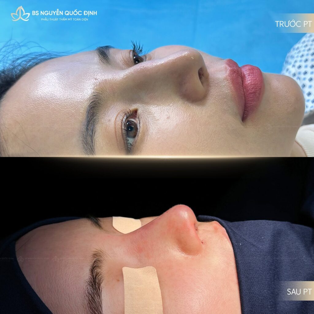 Cải thiện đường viền hàm & Trẻ hoá da