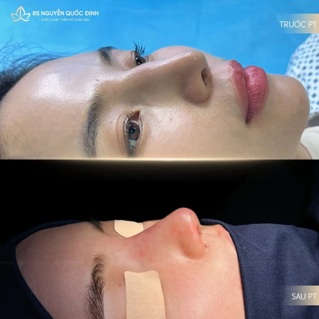 Cải thiện đường viền hàm & Trẻ hoá da