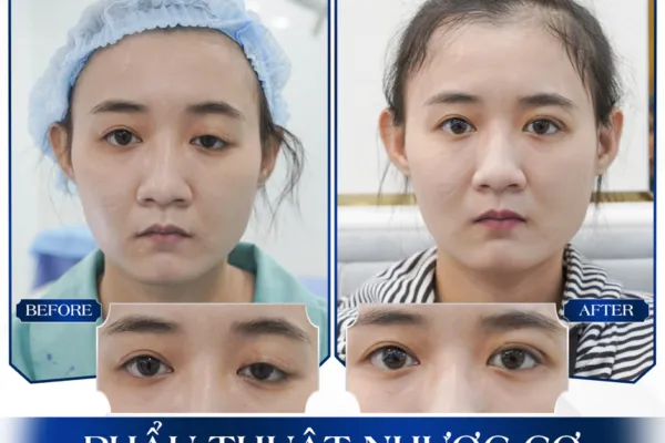 Sửa Mí Mắt Hỏng