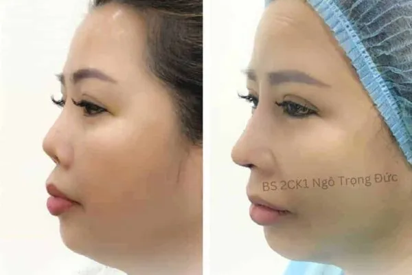 Sửa Mũi Hỏng