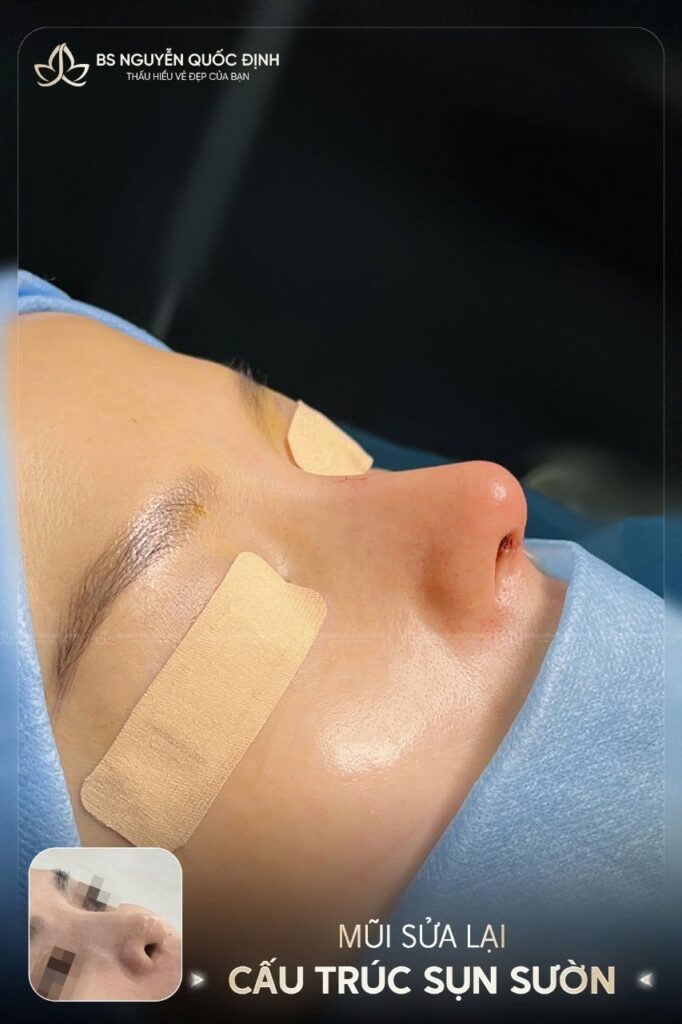 Tái tạo dáng mũi cấu trúc sau biến chứng hỏng
