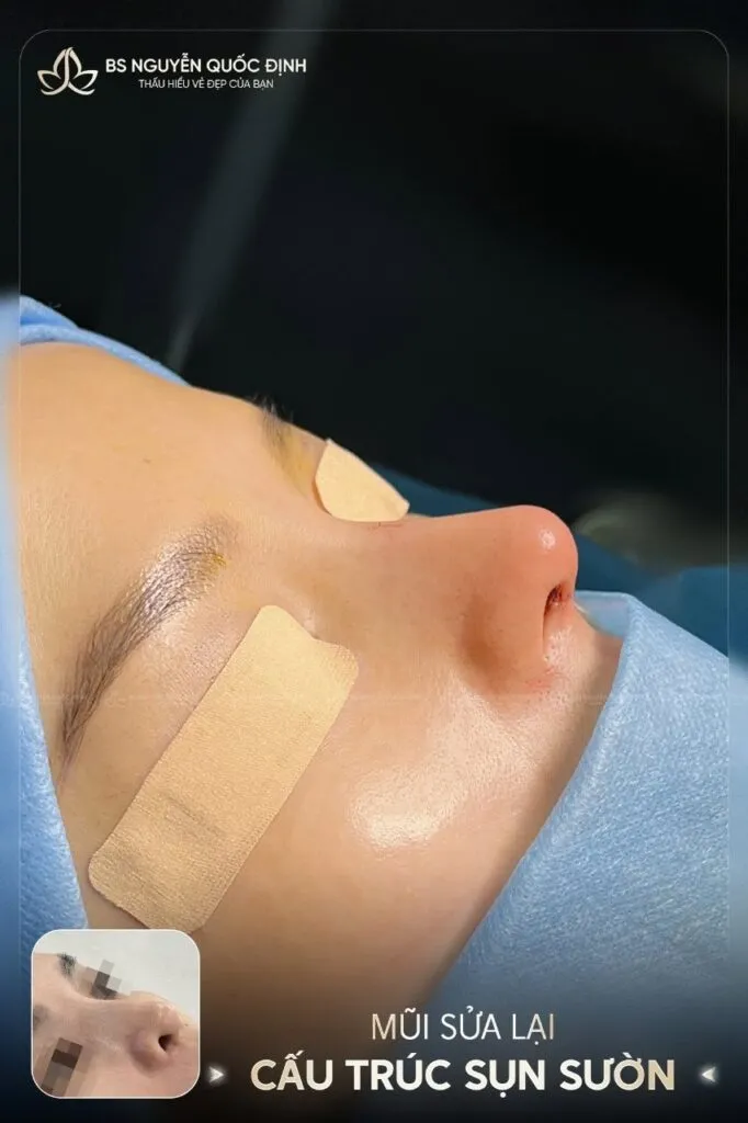 Tái tạo dáng mũi cấu trúc sau biến chứng hỏng