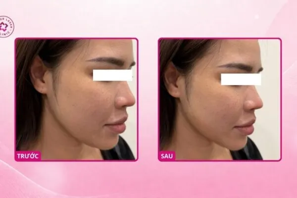 Thon Gọn Góc Hàm