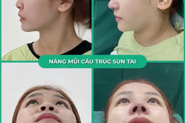 Thu Nhỏ Đầu Mũi
