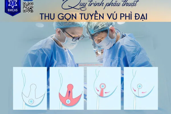 Thu Nhỏ Vú Phì Đại