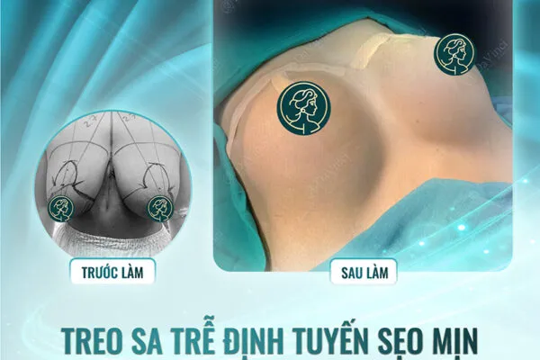 Treo Ngực Sa Trễ