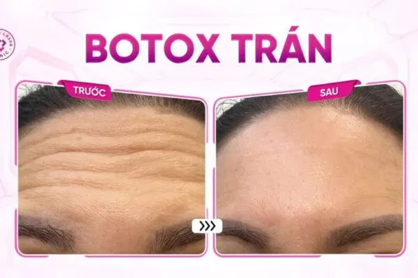 Xóa Nhăn Cơ Trán