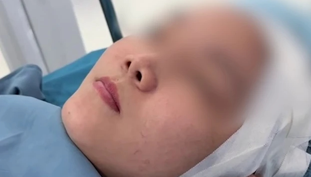 Hậu phẫu thuật nâng mũi, bác sĩ thẩm mỹ cảnh báo dấu hiệu bất thường