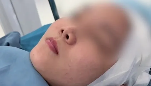 Hậu phẫu thuật nâng mũi, bác sĩ thẩm mỹ cảnh báo dấu hiệu bất thường